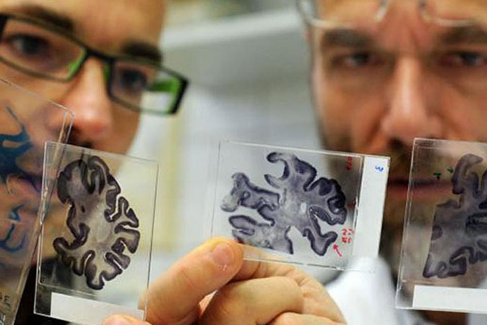 Ученые нашли новую форму болезни Альцгеймера