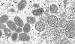 US registers first monkeypox virus-related death