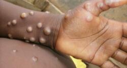 Infection with monkeypox was also detected in this country